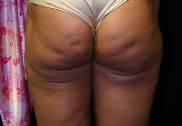 SmoothShapes Cellulite Treatment - Innovations Medical