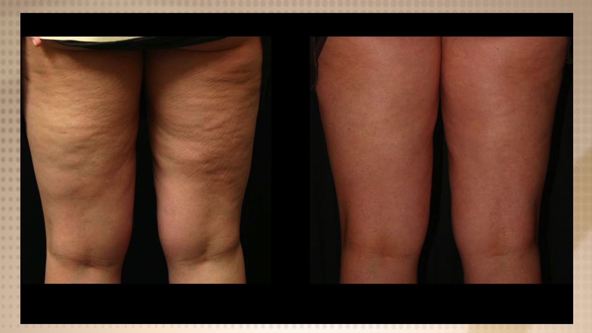 Acoustic Wave Therapy Cellulite Treatment - Innovations Medical