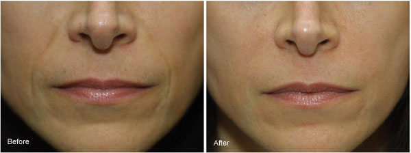 Before Radiesse Dermal Filler