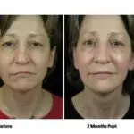 Side-by-side photos of a woman’s face, showing a “Before” image on the left and a “2 Months Post Fat Grafting” image on the right, with subtle improvements in skin tone and smoothness in the post-treatment photo.