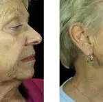 Side-by-side profile photos of an older woman showing her face and neck before and after a cosmetic procedure, such as body sculpting, with the after image displaying smoother skin and a more defined jawline.