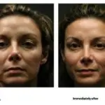 Side-by-side photos of a woman’s face. The left image, labeled before, shows a neutral expression. The right image, labeled immediately after cosmetic surgery Texas, highlights subtle changes in lighting and skin texture.