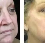 Side-by-side photos of a woman’s face before and after a cosmetic procedure, showing reduced wrinkles, smoother skin, and a more defined jawline in the after image—highlighting the transformative effects of fat grafting.