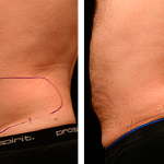 SmartLipo Before and After Stomach