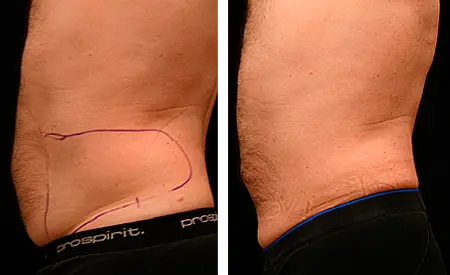 SmartLipo Before and After Stomach