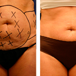SmartLipo Before and After Stomach