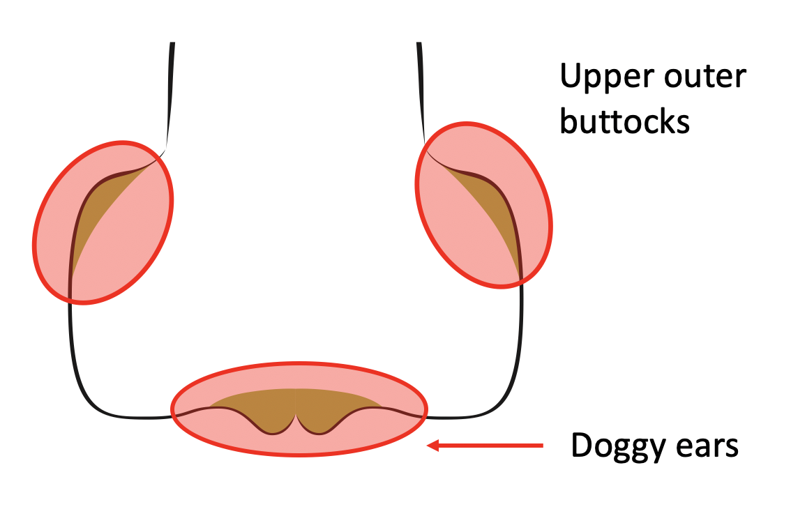 bbl butt shapes