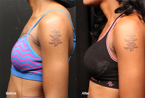 Before and After A to D Cup Breast Augmentation in Dallas, TX, Dr