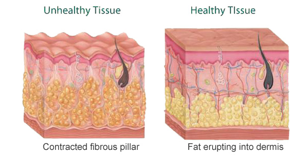 SmoothShapes Cellulite Treatment - Innovations Medical