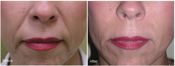 After Radiesse Dermal Filler