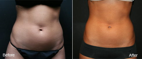 LipoSonix Before and After
