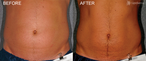 LipoSonix Before and After