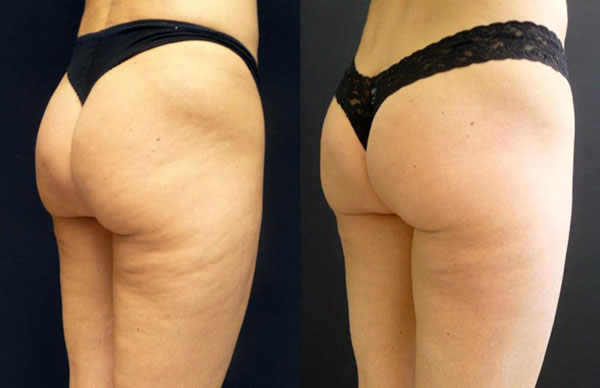 5 SmoothShapes Anti-Cellulite Treatments