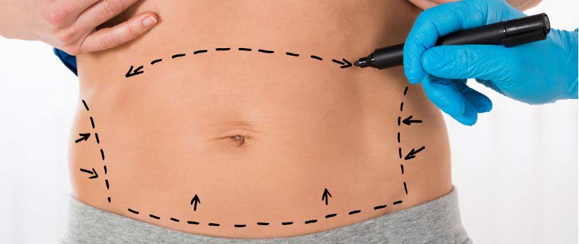 liposuction areas