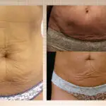 Three close-up images show the lower abdomen of different people, each displaying loose, wrinkled, or sagging skin above the underwear line—common concerns often addressed with cosmetic surgery Texas specialists offer.