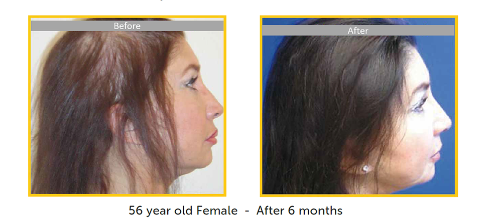 hair restoration for women before and after