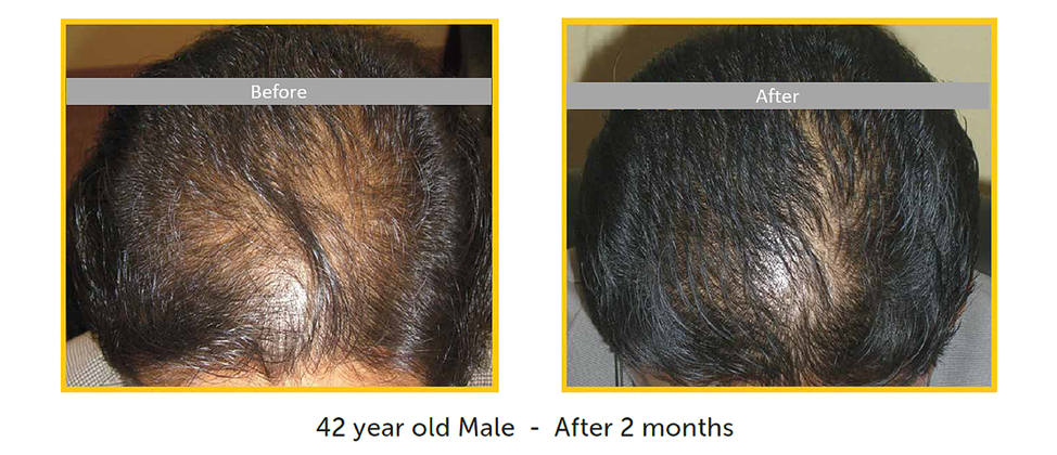 before after male hair restoration