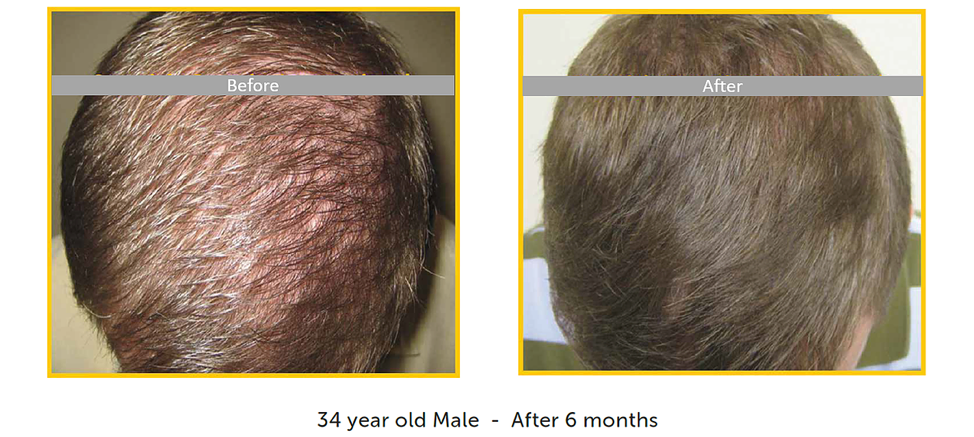 before after male restoration for hair