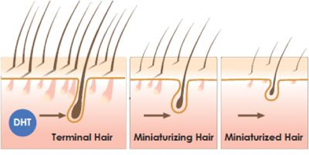 What causes male pattern hair loss? Male pattern hair loss is also referred to as androgenetic hair loss. This is due to the importance of androgens or male hormones on the appearance of hair loss. Specifically, a hormone known as dihydro-testosterone or DHT is primarily for male pattern hair loss. DHT is produced from testosterone and in sensitive men causes a process called “follicular miniaturization” in hair follicles. Follicular miniaturization causes full size hair follicles called terminal hair follicles to shrink. The full size hair follicles produce large adult hairs. 