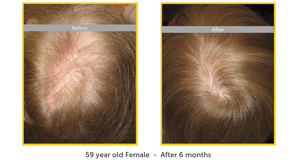 female hair restoration before after