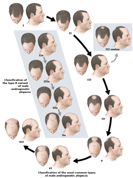 Hair Restoration for Men - Innovations Medical