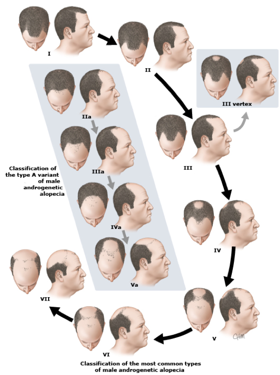 harrison norwood classification system