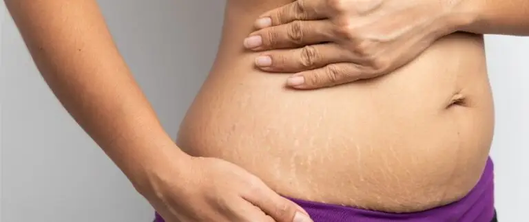 Fraxel Laser For Stretch Marks