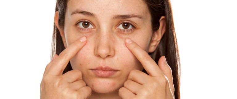 How to Get Rid of Bags Under Your Eyes