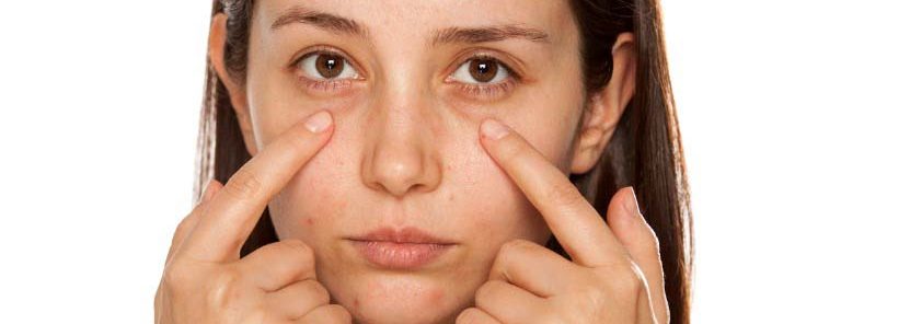 How to Get Rid of Bags Under Eyes