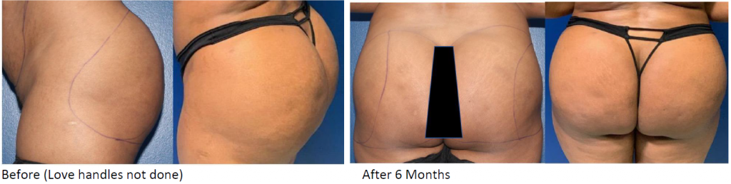 African American Brazilian Butt Lift (BBL) before and after from side and rear