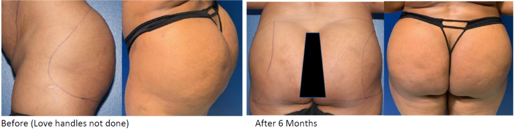 Brazilian Butt Lift (BBL) in Dallas & Fort Worth, TX - Innovations Medical