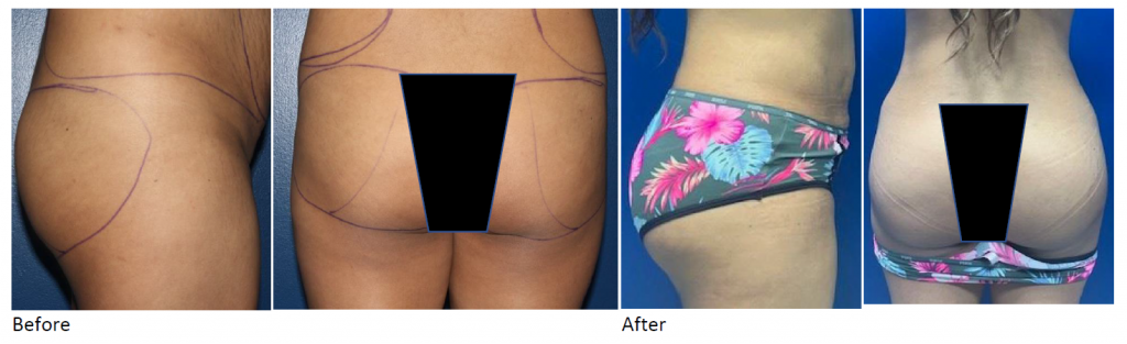 Caucasian Brazilian Butt Lift (BBL) before and after from side and rear