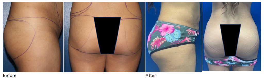 A Brazilian Butt Lift (BBL) with Dr. Triggs can achieve a range of