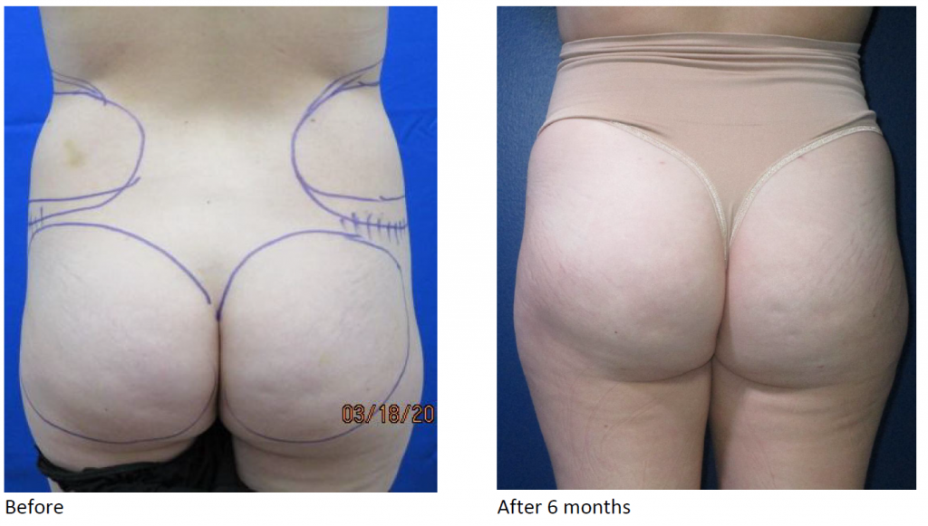 Caucasian Before and after BBL - Brazilian Butt Lift from behind