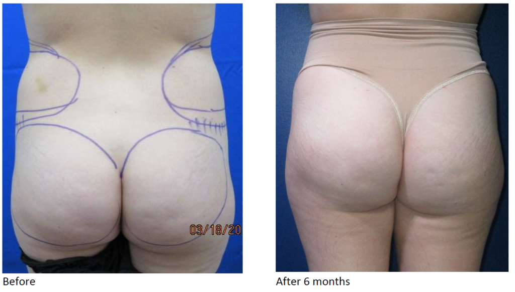 Nordesthetics clinic - BBL (Brazilian buttock lift surgery) is a  combination of liposuction and fat transfer to buttocks. At first, the fat  is taken from a certain body area (abdomen, back, thighs