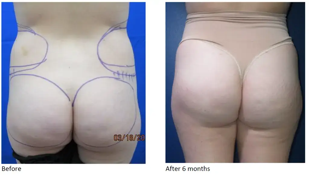 BBL before and after results for a petite patient – Innovations Medical Dallas Brazilian butt lift