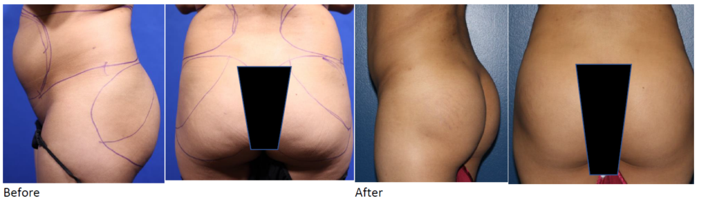 Brazilian Butt Lift (BBL) in Dallas & Fort Worth, TX - Innovations Medical