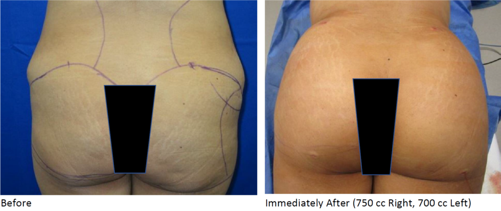 Before and after results of Brazilian Butt Lift (BBL) in Dallas – Innovations Medical