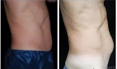 CoolSculpting vs. Liposuction: Cost, Side Effects, Pictures, More