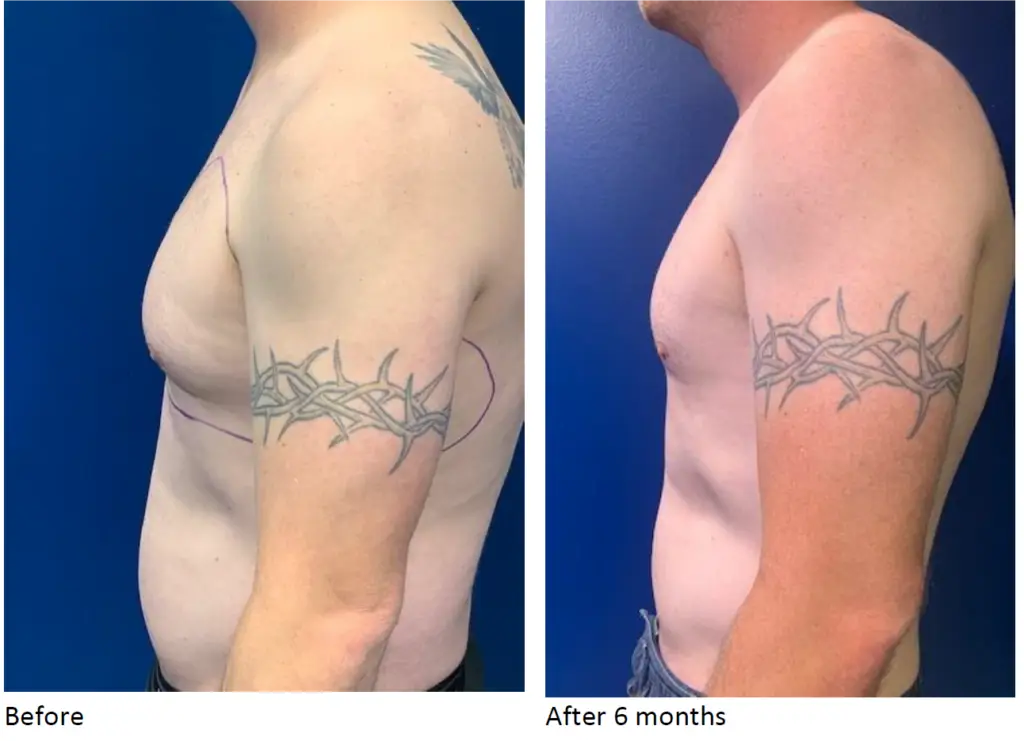 Male Breast Reduction: 5 Proven Benefits for a Flat Chest