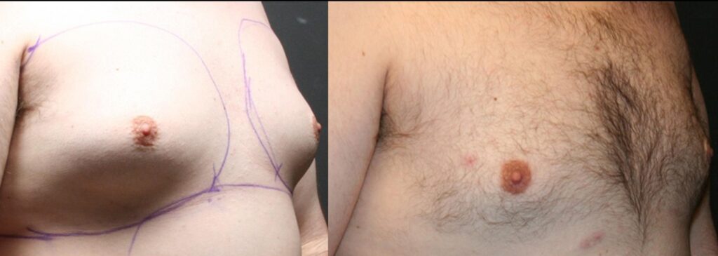 Male Breast (Moobs) reduction before and after