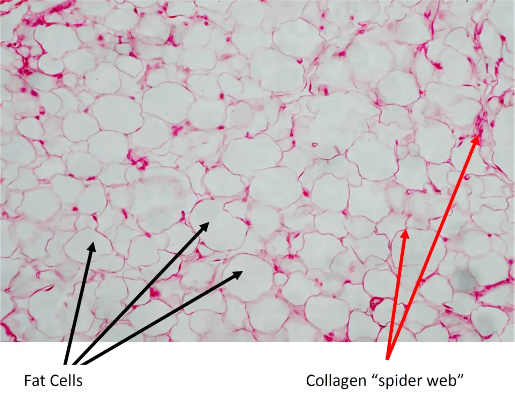 Microscopic view of fat and collagen tissue used in awake liposuction and fat transfer procedures, Awake liposuction dallas