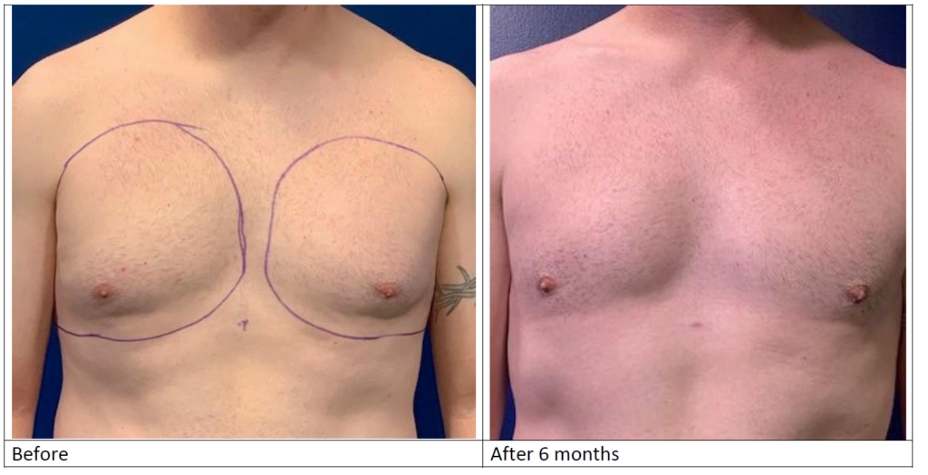 Male breast (Moobs) reduction before and after from front