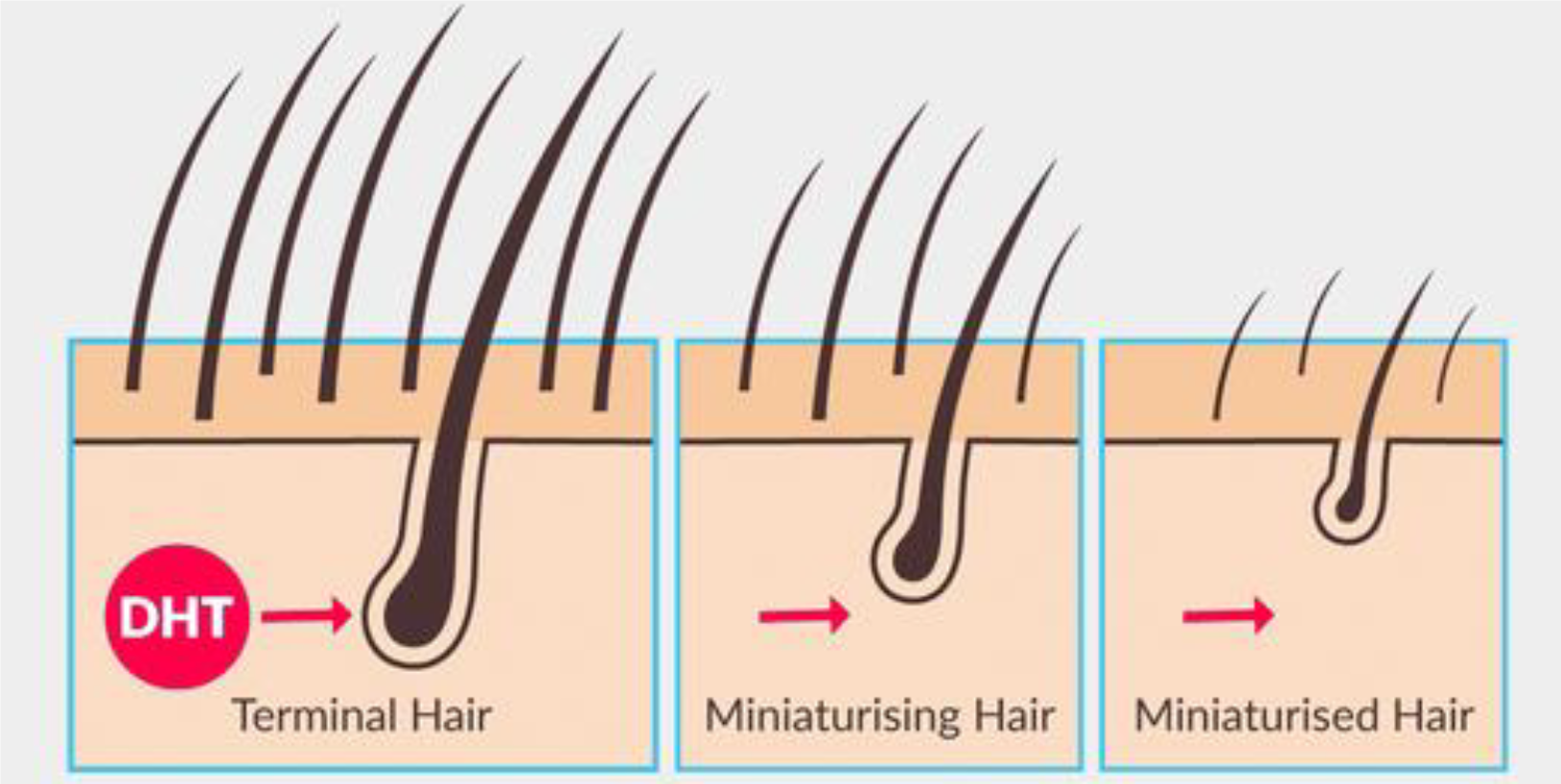 Hair Restoration for Early Hair Loss - Innovations Medical