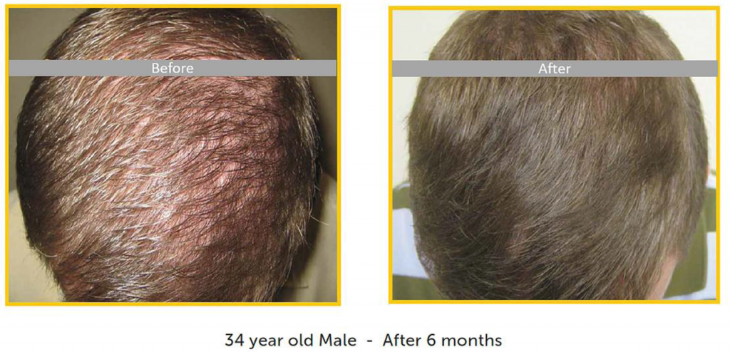 Hair Restoration for Early Hair Loss - Innovations Medical