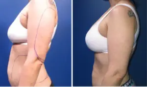 side view natural breast augmentation before and after, white bra, innovations medical dallas