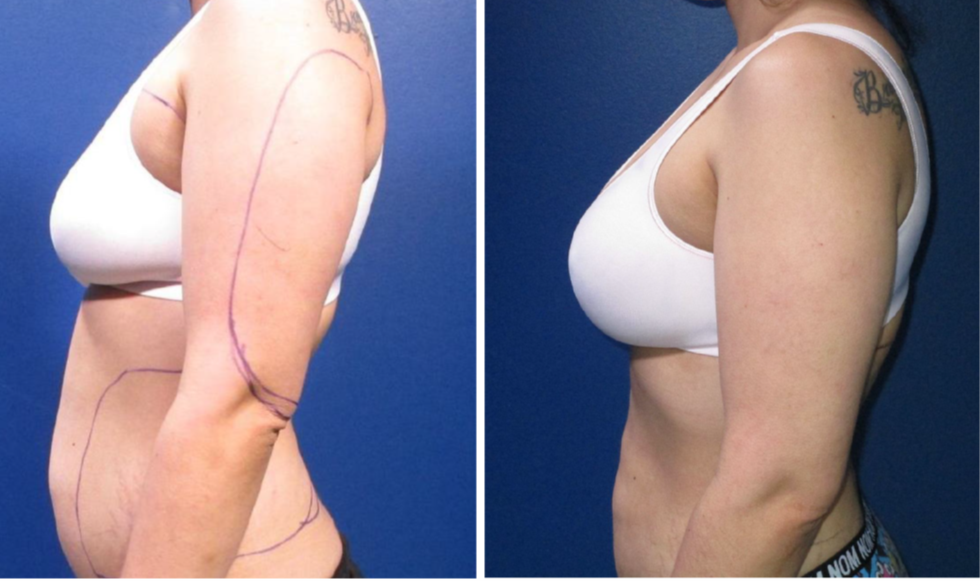 Before and After A to D Cup Breast Augmentation in Dallas, TX, Dr