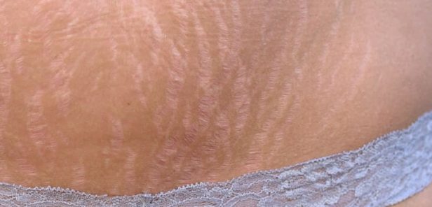 How To Reduce The Appearance Of Stomach Stretch Marks Innovations Medical 