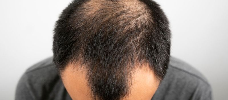 Can You Get a Hair Transplant Without Shaving Your Head? - Innovations  Medical