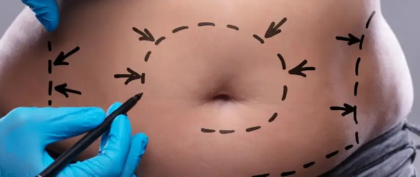 How Much Weight Can You Lose with Liposuction?